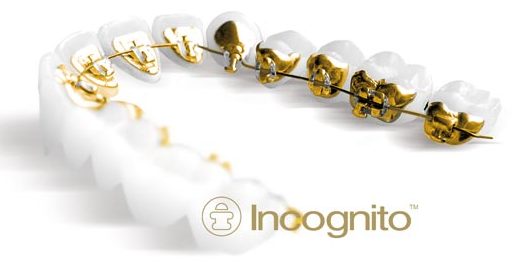 incognito braces
